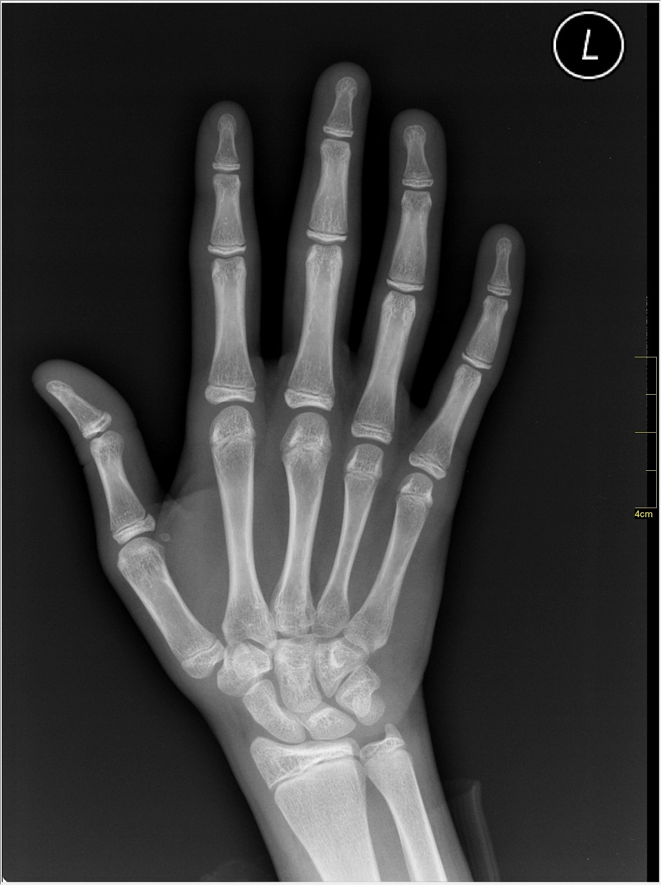 X-ray_of_Hand.jpg
