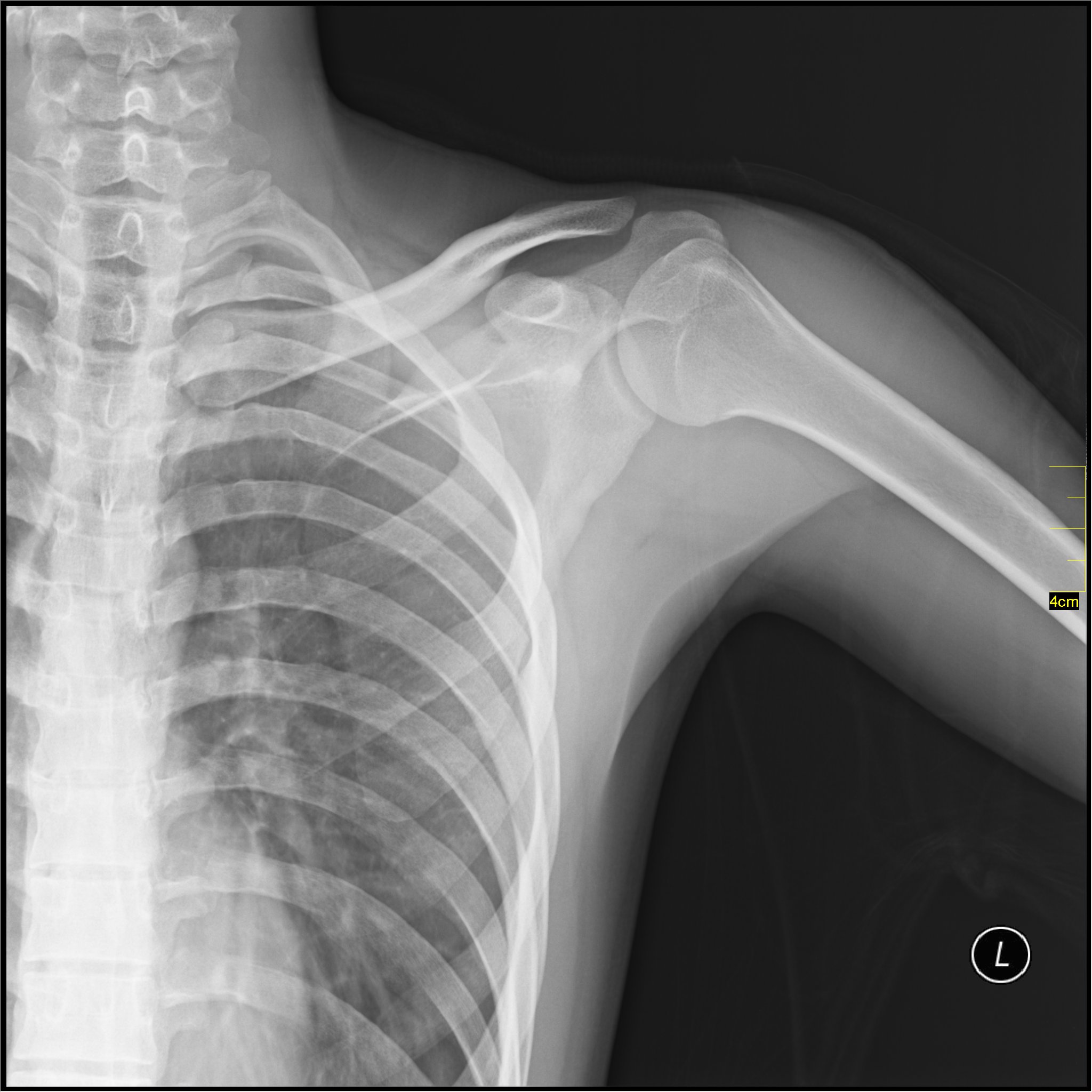 X-ray_of_Shoulder.jpg
