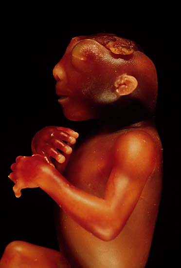 Anencephaly_side.jpg