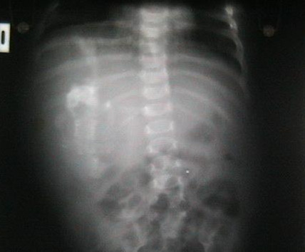Fetus_in_fetu_radiograph.jpg