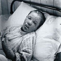 smallpox.jpg