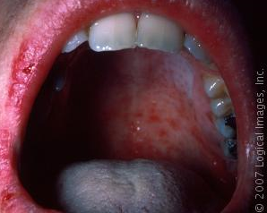 measles%20mouth.png