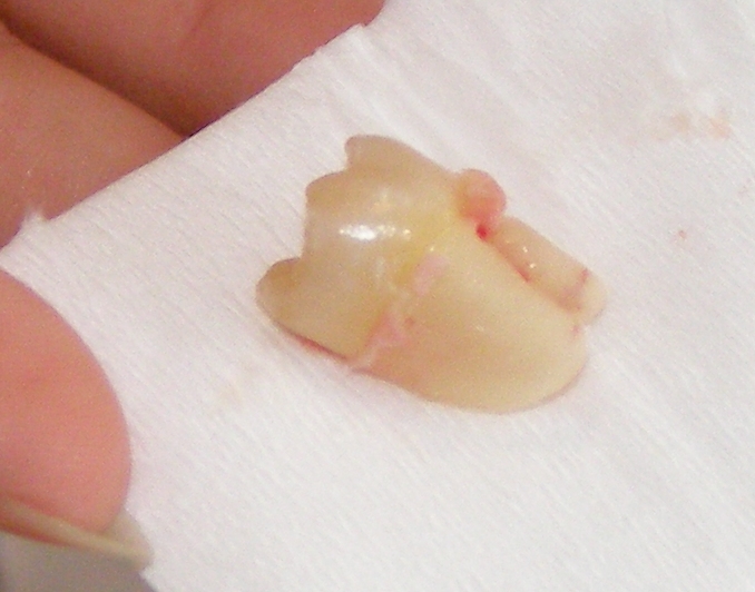 ExtractedTooth.jpg