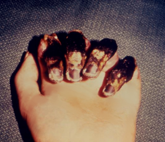 一只手，每根手指都显露出坏疽/感染。