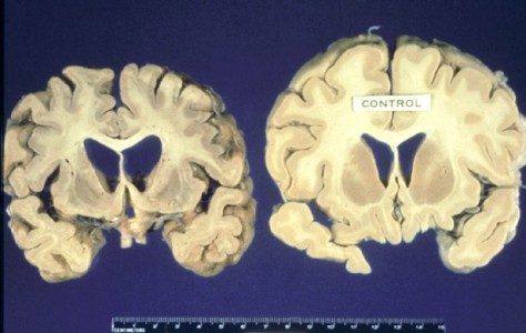 human-brain-with-mad-cow-474x300.jpg